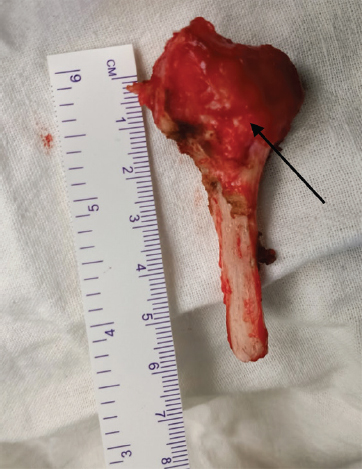 Intra-operative image demonstrating dissection of expanded right proximal fibula (arrow) and excision of proximal fibula around 6 cm of length with normal tumour-free margin.